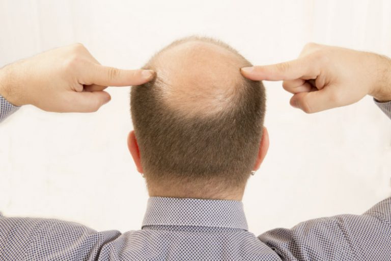 Three Benefits That Come With an FUE Hair Transplant