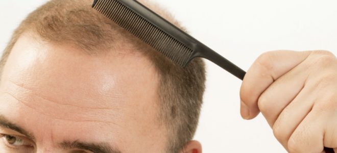 Hair Transplant: Frequently Asked Questions
