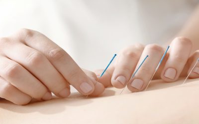 Experience Gentle Healing From Acupuncture For Stress In Bellingham, WA Providers